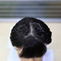 Capelli neri impiantati