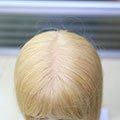 Capelli biondi impiantati